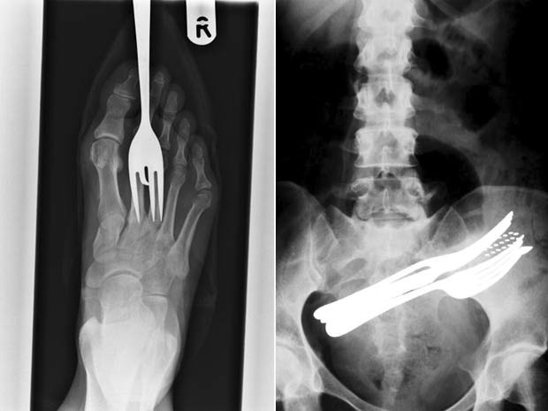 À esquerda, raio-X mostra garfo fincado no pé de um paciente. À direita, imagem do abdômen mostra dois garfos, uma caneta e uma escova de dentes que foram engolidas por um paciente (Foto: Barcroft Media/Getty Images)