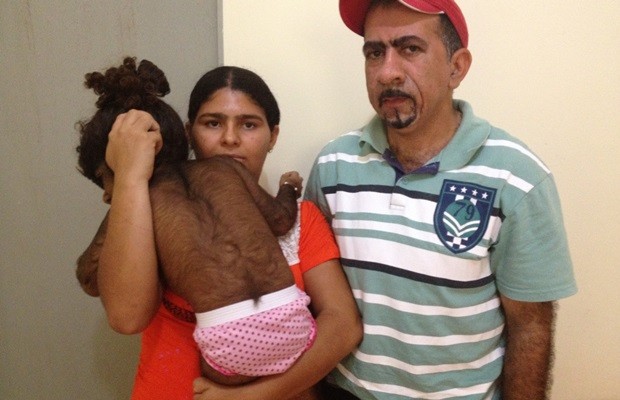 Kemilly Vitória nasceu com o corpo coberto de pelos e pais buscam tratamento (Foto: Fernanda Borges/G1)