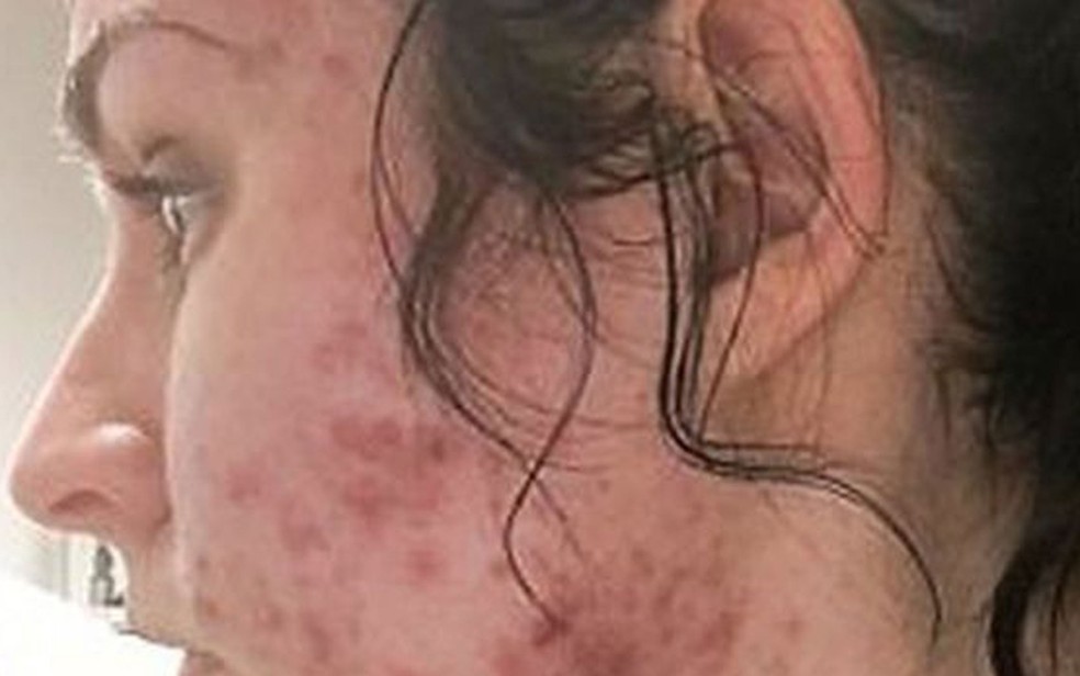 Judith diz que na adolescência teve espinhas mas o problema ficou grave quando completou 23 anos (Foto: Judith Donald)