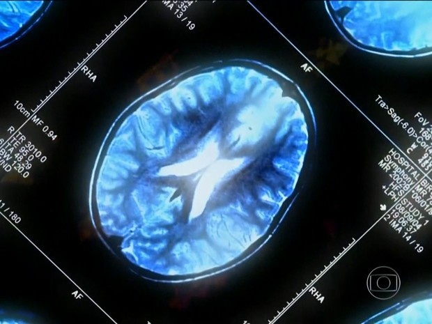 Medicamento experimental, quando tomado como droga única contra Alzheimer, foi capaz de desacelerar progressão da doença (Foto: Rede Globo)