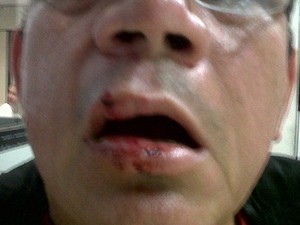 Investigador Daniel Nascimento com ferimentos nos lábios, após suposta agressão por PMs. (Foto: Divulgação / Sindpol)
