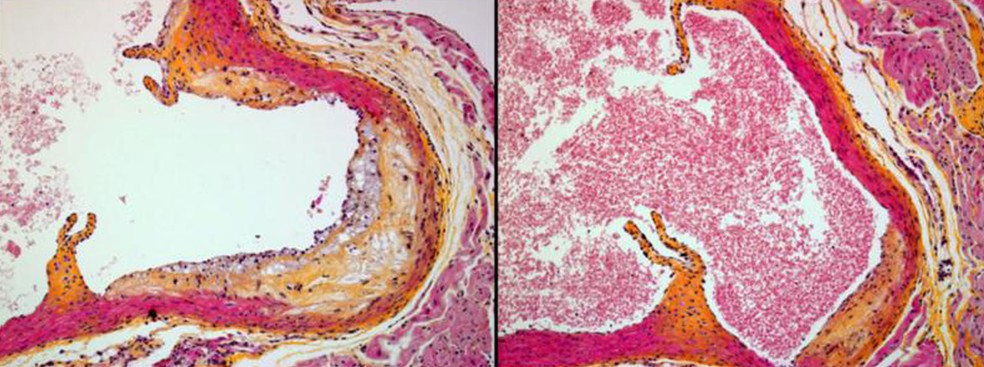 Imagem à direita mostra corte de aorta em camundongo imunizado com AT04A com pouca placa. À esquerda, aorta de camundongo que não foi imunizadao, com formação de placa (Foto: The Netherlands Organisation of Applied Scientific Research/Divulgação)