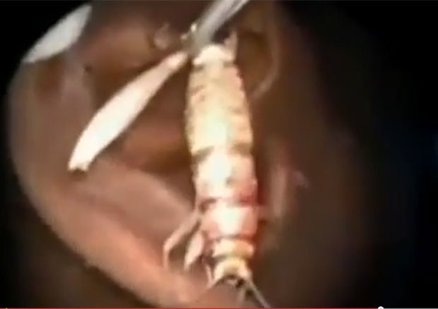 Médicos retiram inseto de sete centímetros ainda vivo do ouvido de paciente (Foto: Reprodução/YouTube/Jerry Maguire)