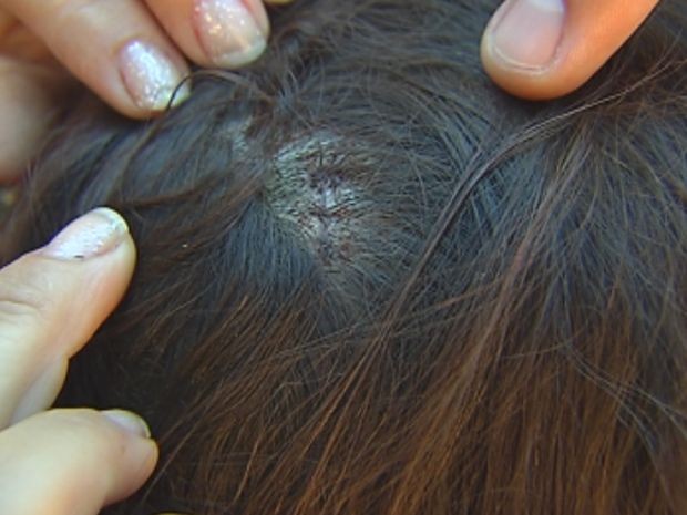 Menina levou dois pontos na cabeça após ser atingida por pedaço da guitarra.  (Foto: reprodução/TV Tem)