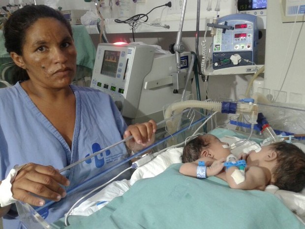 Eliane Lima acompanha na UTI os filhos que nasceram unidos pelo abdômen (Foto: Waldson Costa/G1)