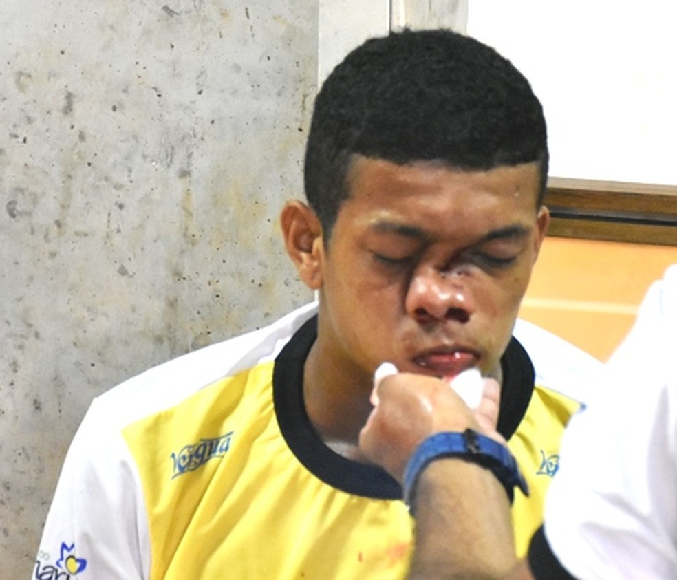 Alexandre Lima, zagueiro da Adesg sofre fratura no nariz, após lance normal em duelo do Acreano Sub-20 (Foto: Manoel Façanha/arquivo pessoal)