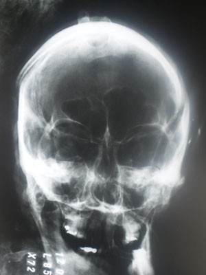 Radiografia do crânio de Marcos Matsunaga; empresário levou tiro na cabeça (Foto: Reprodução)