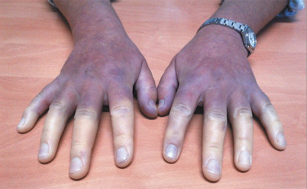 Dedos da paciente ficam brancos quando expostos ao frio (Foto: The New England Journal of Medicine/Salvador Labrador/Miguel A. Gonzalez-Gay)