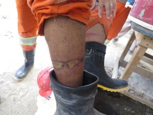 Em um grupo de 13 trabalhadores, seis tinham lesões dermatológicas nas pernas (Foto: Mariana Banja/Ascom/MPT-PE)