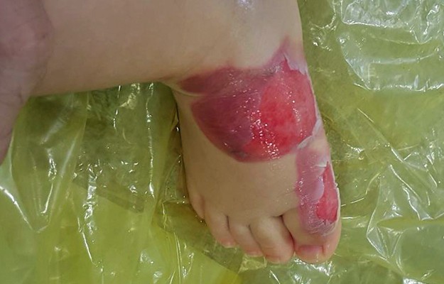 Miguel teve queimaduras de 2° grau nos pés (Foto: Fernanda Aguiar/Arquivo Pessoal)