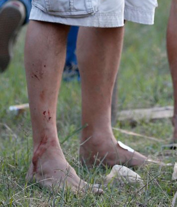 Pernas machucadas de Marcello Antony após acidente (Foto: Felipe Panfili/AgNews)