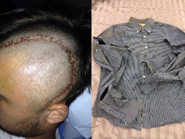 Lucas Borgo sofreu traumatismo craniano. Camisa usada por ele no dia da agressão ficou rasgada (Foto: Sandra Borgo/Arquivo Pessoal)