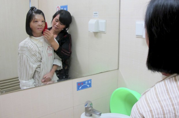 A garota Xu Jianmei, de 17 anos, passou por uma reconstrução de face. (Foto: Reuters/China Daily)
