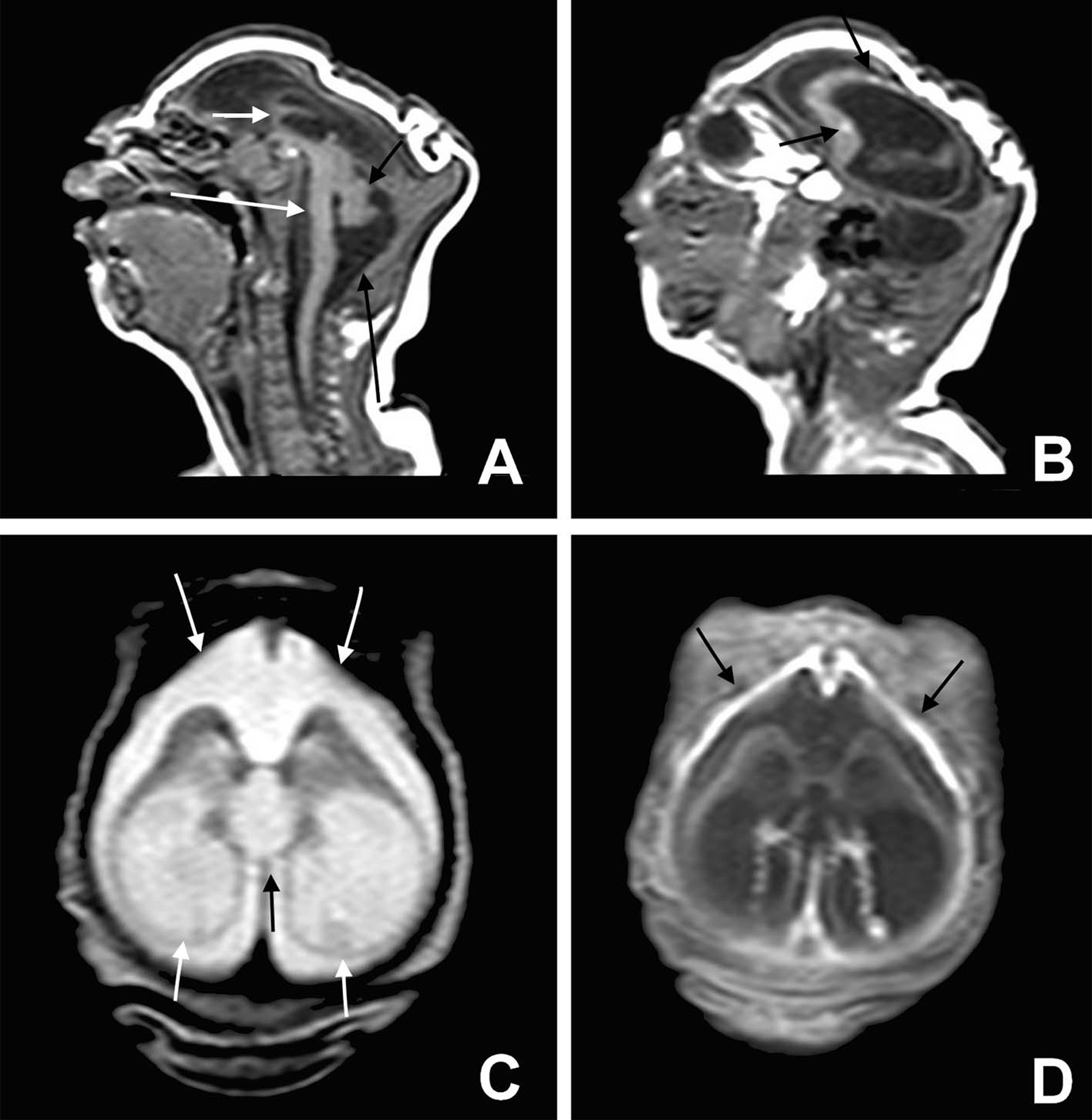  Exame de imagem revela danos cerebrais de bebês com microcefalia (Foto:  BMJ 2015/ http://www.bmj.com/cgi/doi/10.1136/bmj.i1901 )