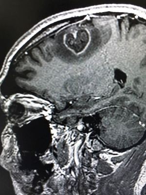 Tumor em forma de coração foi retirado do cérebro (Foto: Arquivo Pessoal)