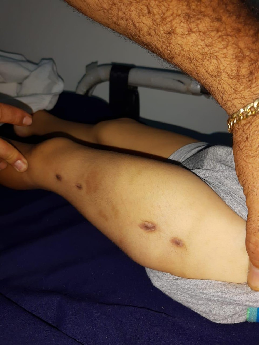 Foto mostra hematomas no corpo do menino — Foto: Arquivo pessoal