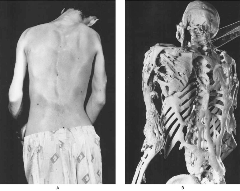 Postura rígida de homem de 25 anos com FOP. Placas de osso característico contornam a pele (A) e podem ser vistas diretamente no esqueleto (B) (Foto: Museu Mütter)