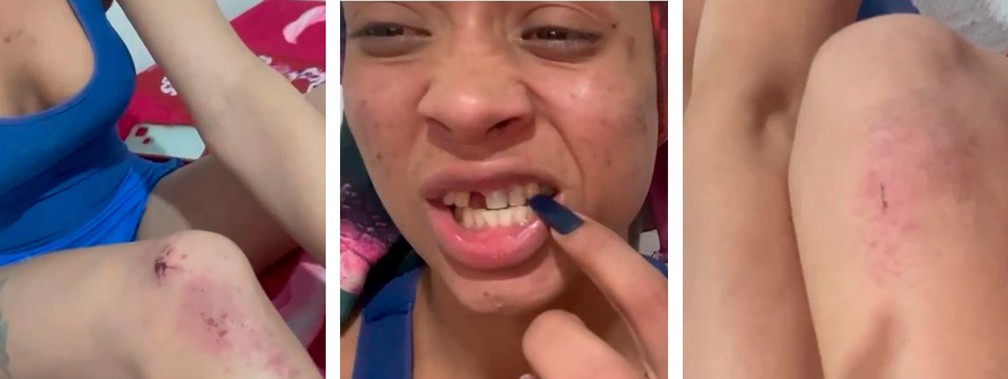 Priscyla Rodrigues mostra machucados e dente quebrado ap&oacute;s ser agredida por homem desconhecido &mdash; Foto: Reprodu&ccedil;&atilde;o/Arquivo pessoal