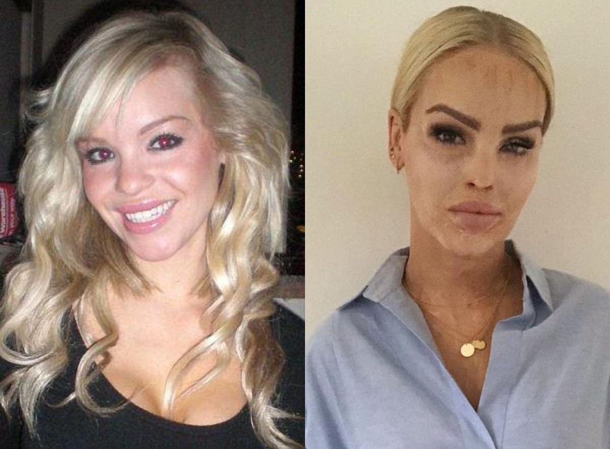 Katie Piper (Foto: Reprodução/Instagram)