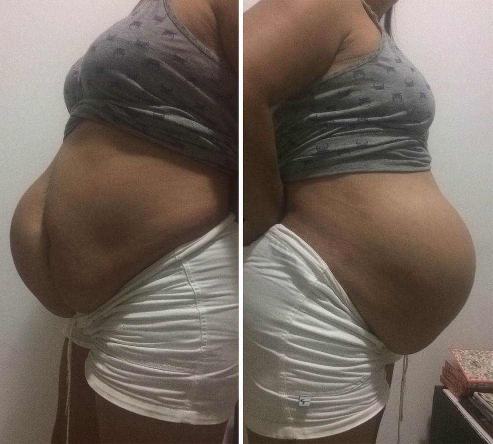 Dona De Casa Espera Ha Anos Para Retirar Hernia Gigante Nao E So A Dor E O Psicologico Sorocaba E Jundiai G1