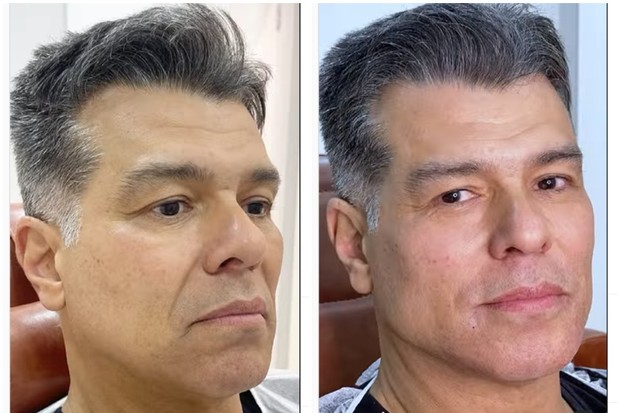 Antes e depois de harmonização facial de Maurício Mattar (Foto: Reprodução/Instagram)