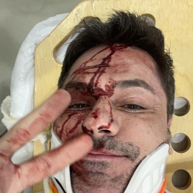 Danilo Faro, irmão de Rodrigo Faro, mostra rosto machucado após acidente de carro (Foto: Reprodução/Instagram)