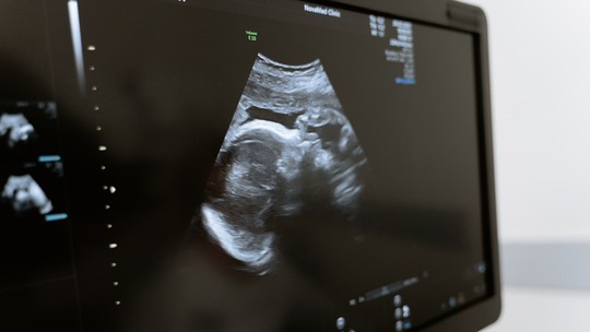 Engravidar de novo logo após aborto espontâneo não é mais arriscado, sugere estudo
