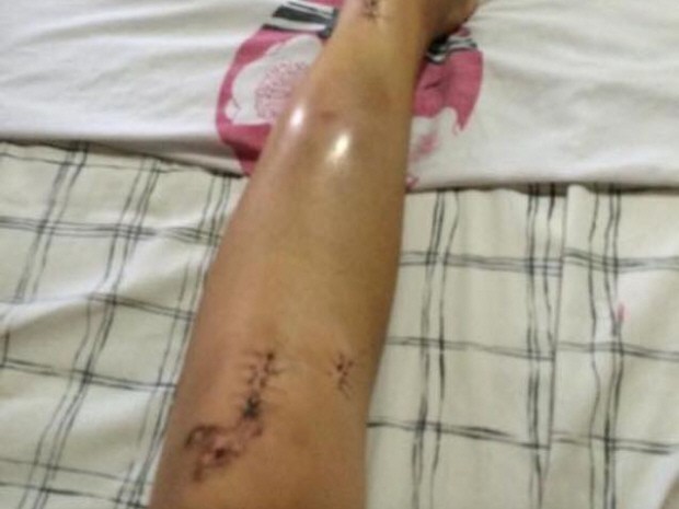 Estudante teve de passar por cirurgia na perna (Foto: Larissa Magalhães / Arquivo Pessoal)