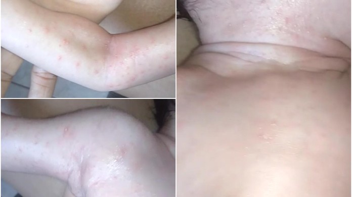 Mae Denuncia Que Bebes Estao Saindo De Maternidade Do Ac Com Infeccao De Pele Insalubre Acre G1