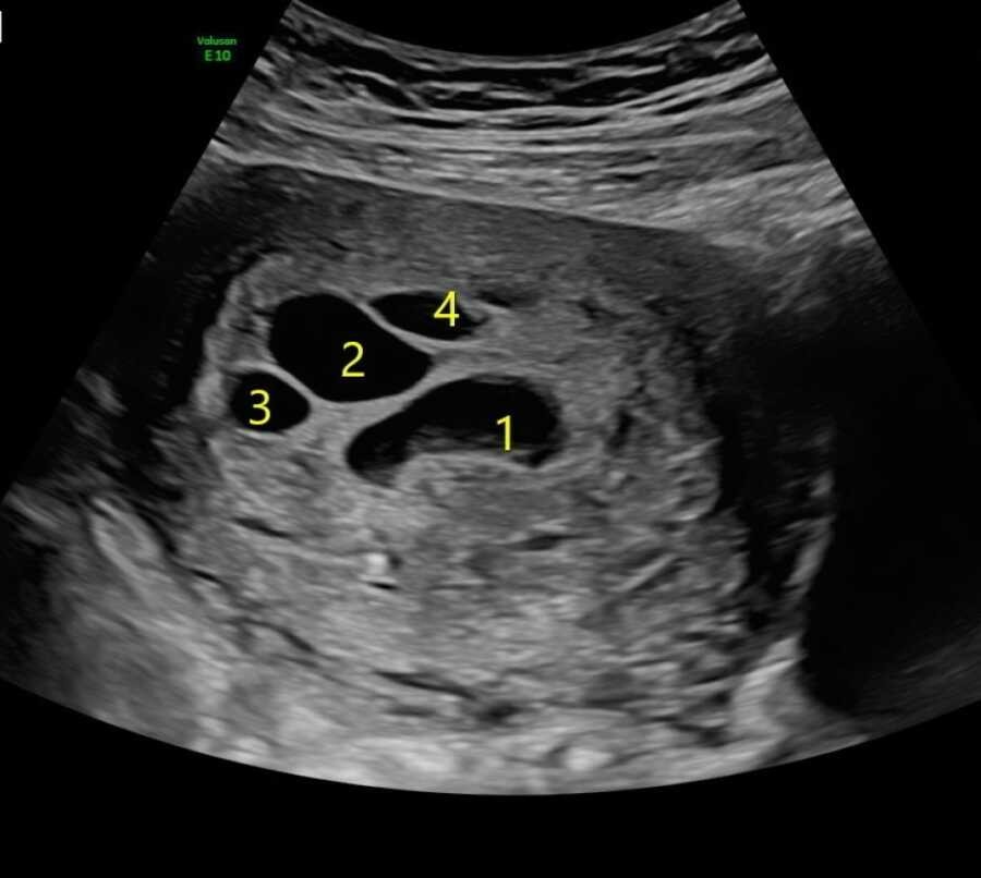 Os sacos embrionários que apareceram no ultrassom (Foto: Reprodução/ Love what matters)