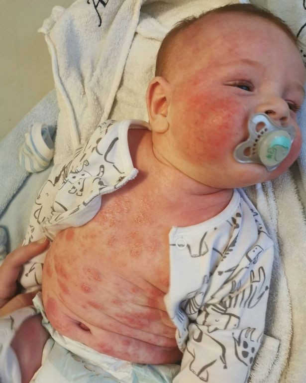 Demorou sete meses até que o bebê pudesse ser diagnosticado com APLV (Foto: Reprodução/The Mirror)