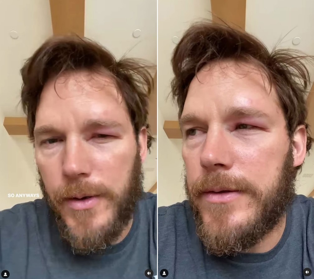 Chris Pratt mostra rosto inchado após ser picado por abelha