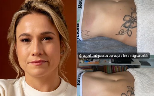 Fernanda Gentil mostra antes e depois de barriga após drenagem; vídeo