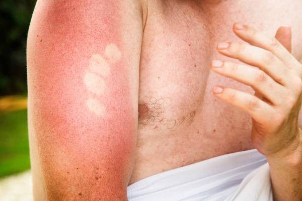 Queimaduras causadas pela exposição ao sol: saiba o que fazer