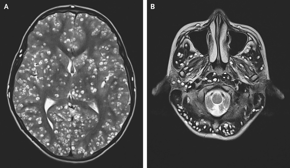 Exame mostra os nÃ³dulos causados por ovos de parasitas em cÃ©rebro de jovem indiano â€” Foto: ESIC Medical College/DivulgaÃ§Ã£o