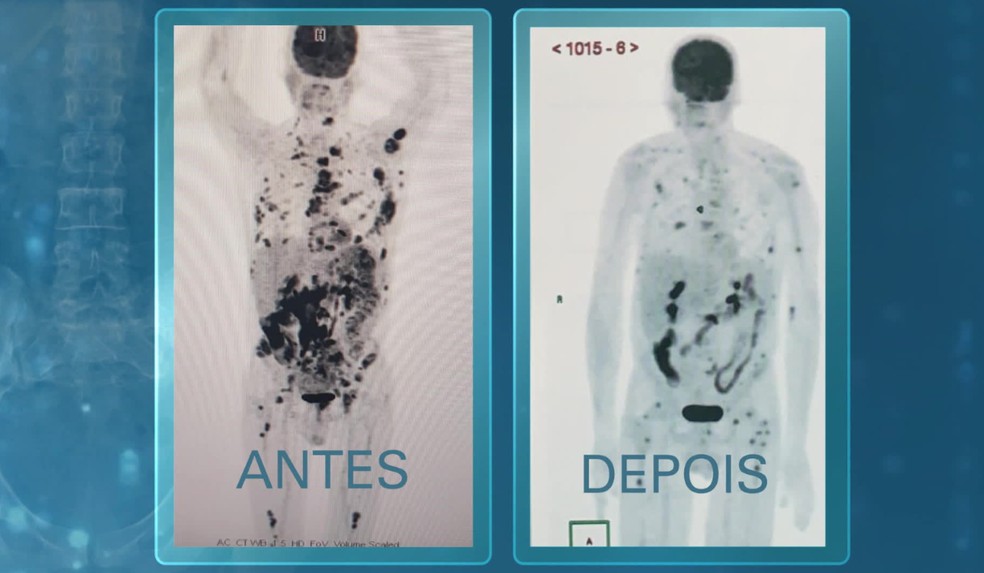 Manchas pretas no exame são tumores. O primeiro foi realizado há um mês, quando o paciente chegou ao hospital. Nesta semana, o resultado do exame mostra que a maioria das manchas desapareceu, e as que restam sinalizam a evolução da terapia.  — Foto: Reprodução/Fantástico