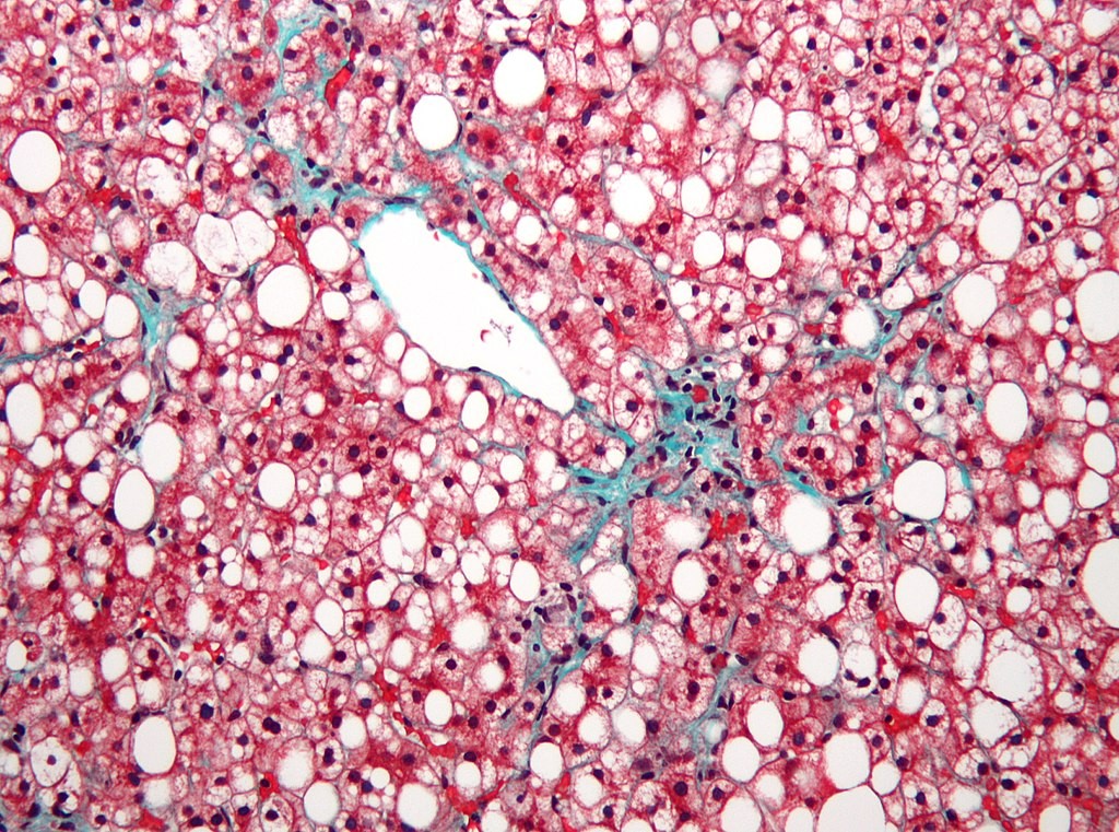 Micrografia das células de um fígado com doença hepática gordurosa não alcoólica. Espaços em branco são a gordura, enquanto fibrose leve está em verde e células saudáveis em vermelho (Foto: Wikimedia Commons)