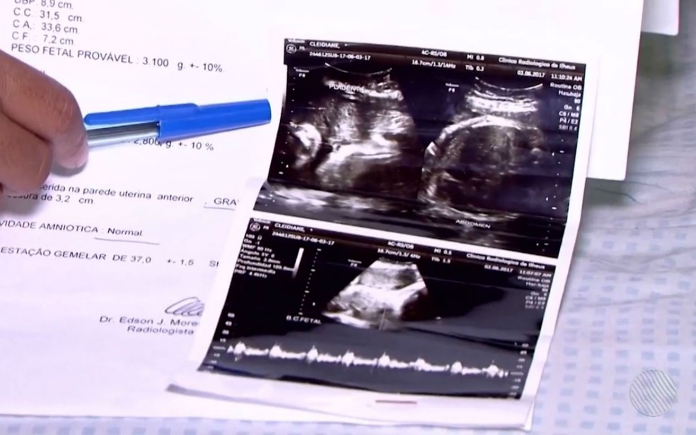 Mulher disse que fez ultrassonografia e que estava esperando gêmeos (Foto: Reprodução/TV Bahia)