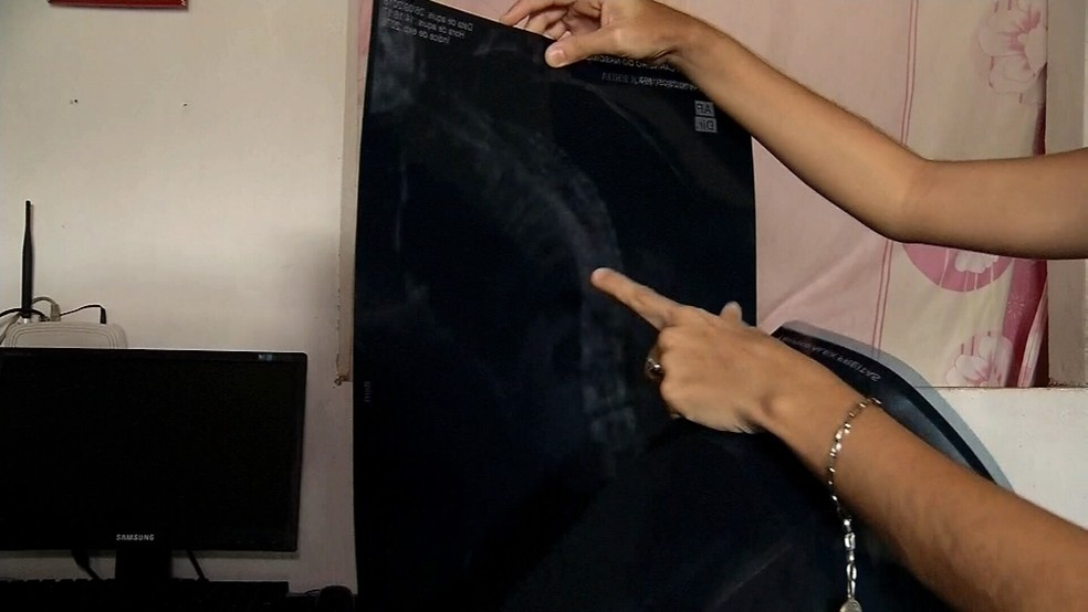 Ramayana Carneiro sofre com escoliose idiopática desde os oito anos e pede ajuda para realizar cirurgia — Foto: TV Verdes Mares/ Reprodução