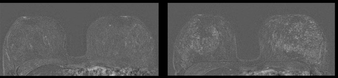 À esquerda, RM de mama em paciente de 41 anos sem DIU; à direita, imagem mostra aumento do fundo do parênquima na mesma paciente 27 meses após a colocação do DIU (Foto: RSNA)