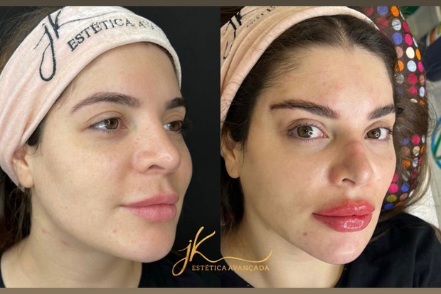 GKay antes e depois de procedimentos estéticos (Foto: Reprodução/Instagram)