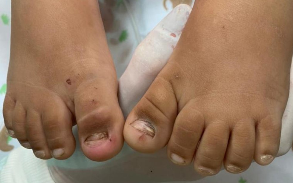 Menina é levada a hospital sem unhas do pé, em Goiânia, Goiás — Foto: Reprodução/TV Anhanguera