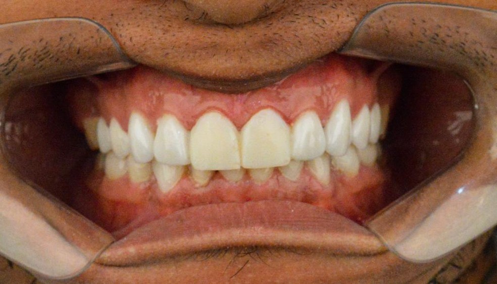 Otero Do Corinthians Vai Ao Dentista Recolocar Lentes Perdidas Contra O Atletico Go Corinthians Ge