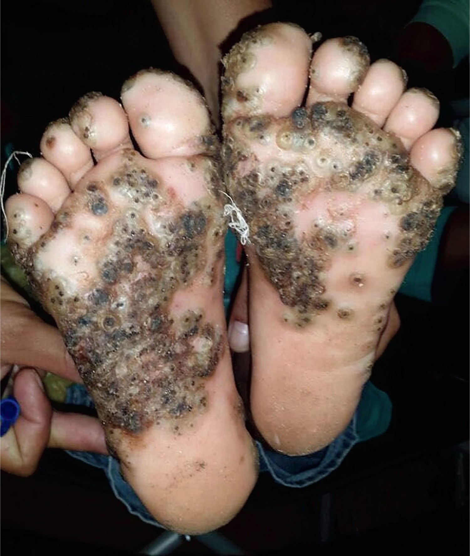 Imagem surpreendente dos pés da paciente de 10 anos (Foto: NEJM/ Reprodução)