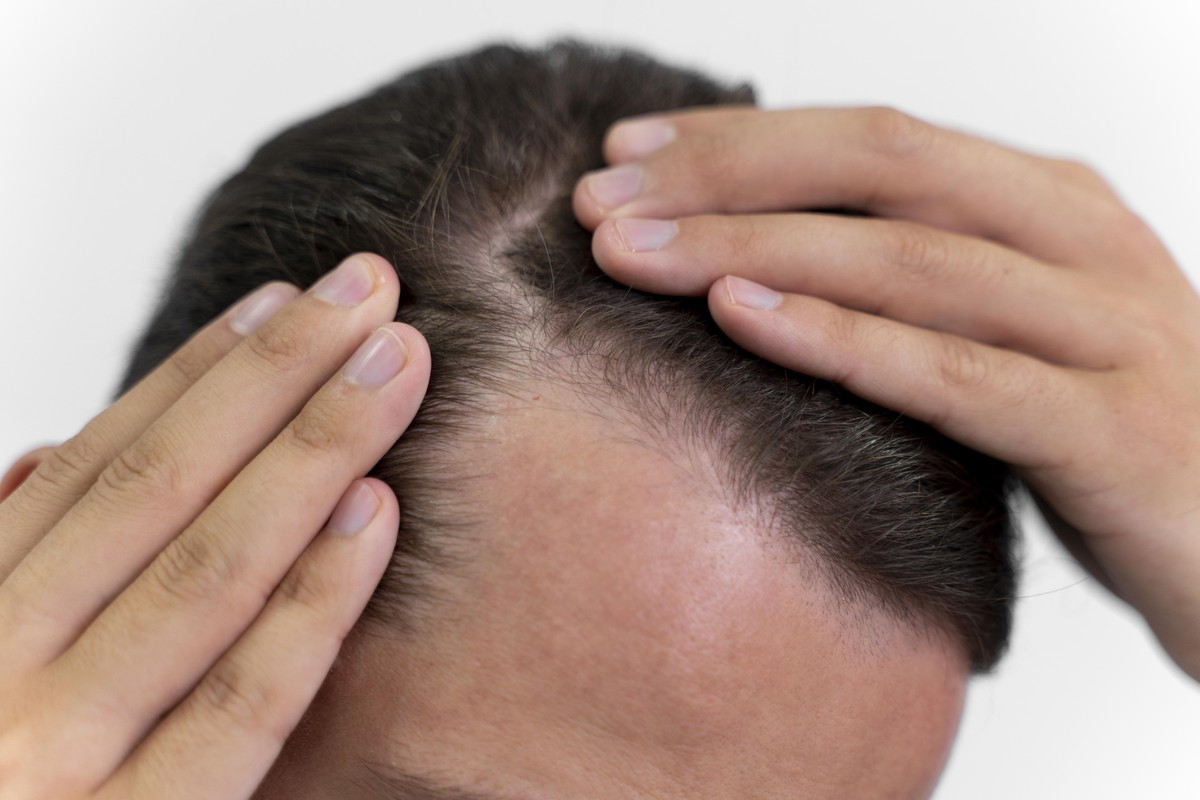 Minoxidil: para que serve, como usar de forma correta e efeitos colaterais