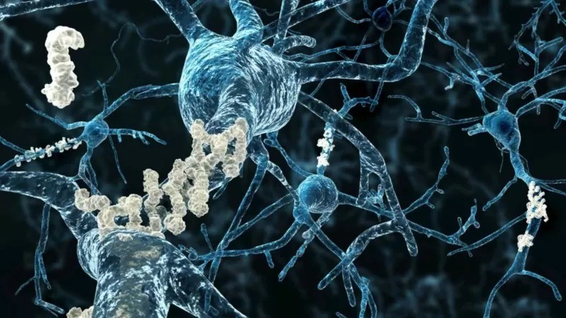 Placas amiloides são visíveis em neurônios afetados pela doença de Alzheimer (Foto: GETTY IMAGES via BBC)