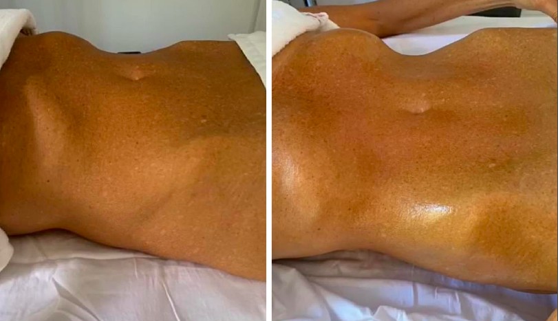 A modelo Elle Macpherson antes e depois de seu tratamento para secar a barriga (Foto: Instagram)