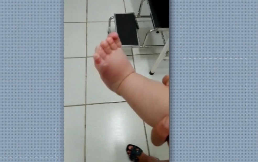 Polícia Civil abre inquérito para investigar queimaduras em bebê de 7 meses em Pouso Alegre — Foto: Reprodução EPTV