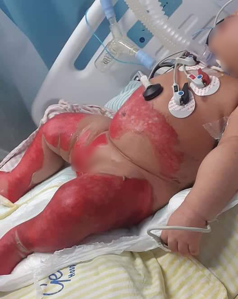 Juliana Duarte Anastácio sofreu queimaduras no Getulinho, em Niterói — Foto: Reprodução