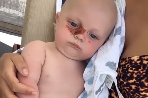A foto compartilhada pela socialite, modelo e estrela de reality show Chloe Lewis mostrando o efeito da reação alérgica do filho (Foto: Instagram)